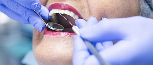 Best Knocked-Out Tooth (Avulsed Tooth) Treatment in Spring Mount, PA